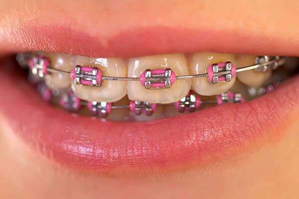 Metal Braces, Saddle Creek Orthodontics