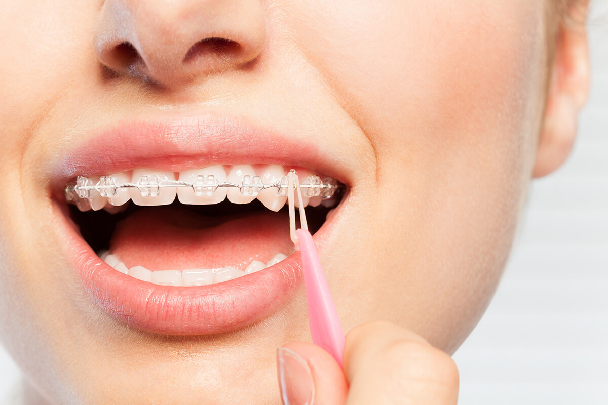 A Rubber Band's Job With Braces Smith Orthodontics